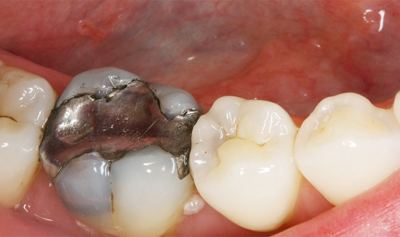 Amalgame usé, parois dentaires fragilisées