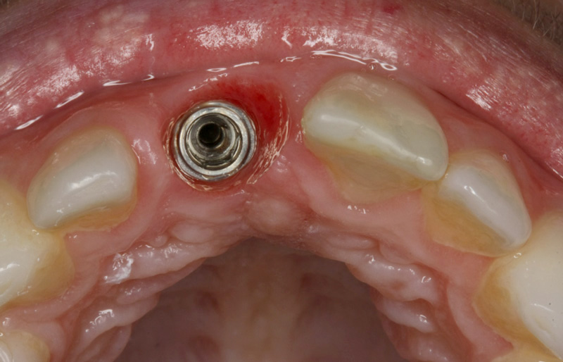 Implant posé et reconstitutions en composite des incisives adjacentes