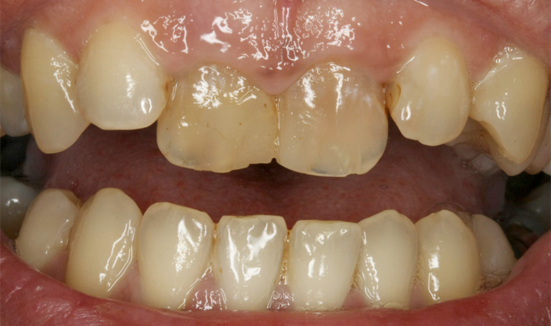 Incisives centrales colorées avec niveau gingival trop bas