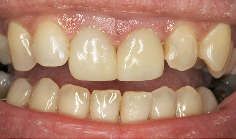 Rehaussement du niveau gingival (laser Co2) et recouvrements complet en composite